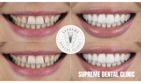 DENTAL VENEERS: WHAT ARE THE TYPES AND THEIR DIFFERENCES?