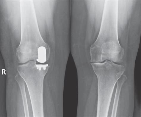 NYC Medial Partial Knee Replacement | Robotic Partial Knee Replacement