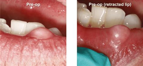 Fibroma Removal