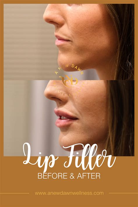 Lip Filler Before & After from A New Dawn Wellness Center in Scottsdale ...