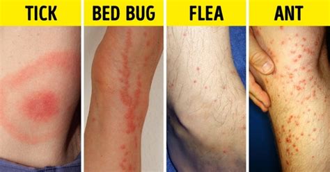 Insect Bites That Look Like Mosquito Bites It s important to prevent ...