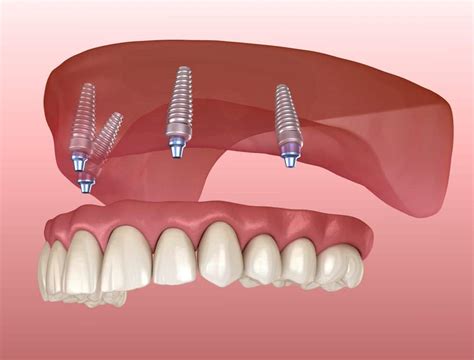 All on Four Implants | Snap In Dentures | Memphis