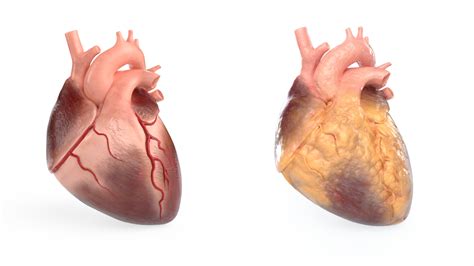 Arman Dalay - Healthy vs. fatty heart