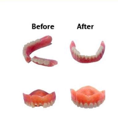 Where Can I Get My Dentures Repaired? Dr. Barry Kaplan, Morristown