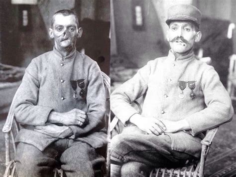 A disfigured French veteran of the First World War demonstrates face ...