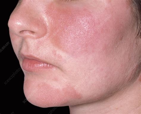 Mild Seborrhoeic Dermatitis