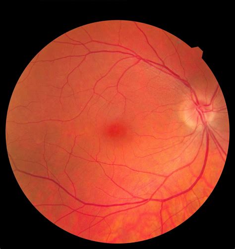 Eye Problems Common in COVID-19 Patients