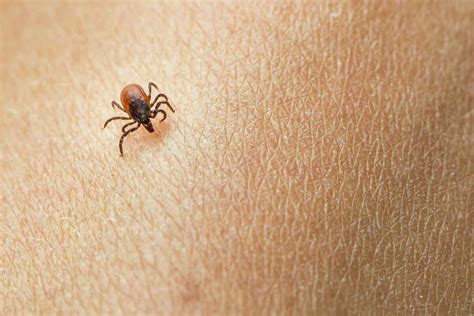 These horrifying pictures show the exact tick bite symptoms to look for