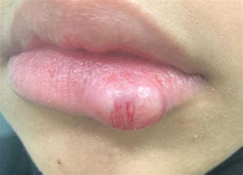 Cureus | Unusual Lower Lip Swelling: A Rare Case of Lip Schwannoma