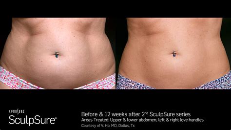 Laser Body Contouring - Before and After | SculpSure