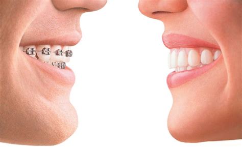 Here’s How To Tell Overbite Vs Normal Teeth Bite