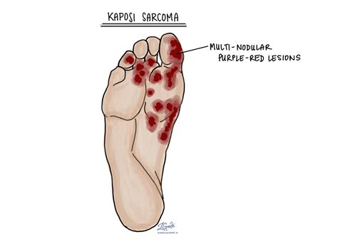 Kaposi sarcoma - MyPathologyReport.ca