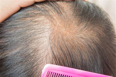 Thinning hair: Causes, types, treatment, and remedies