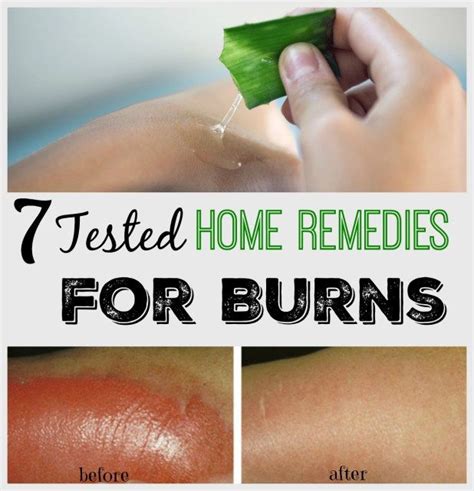 Home Remedies for Burns | Home remedies for burns, Burn remedy, Remedies