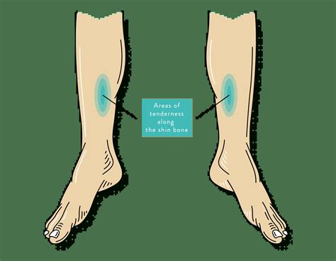 Shin Splints: Causes, Symptoms & Treatment | The Foot Hub