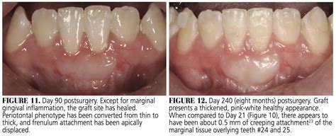 Healing Progression of the Free Gingival Graft - Decisions in Dentistry