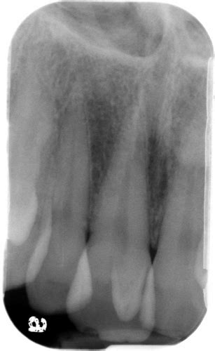 Case of the week: Talon cusp with clinical photo – Dr. G's Toothpix