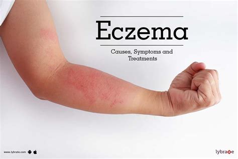 Eczema - Causes, Symptoms and Treatments - By Dr. Himanshu Singhal | Lybrate