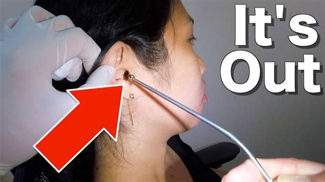 Removing Woman's Hard Impacted Earwax Stuck Deep in Her Ear Canal - YouTube