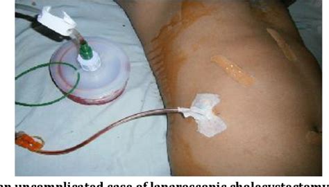 Figure 2 from USE OF 14-F VACUUM DRAIN IN LAPAROSCOPIC CHOLECYSTECTOMY: A PROSPECTIVE ANALYSIS ...