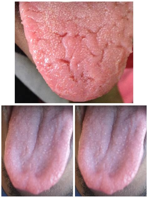 Tongue Abnormalities | International Journal of Clinical & Medical Images