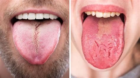 11 Things Your Tongue Can Tell You About Your Health | 6 Minute Read in ...