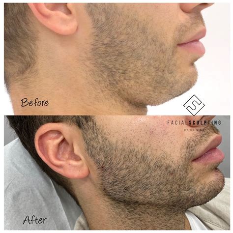 How Dermal Fillers Can Change the Jawline in Men | Doctor Lanna