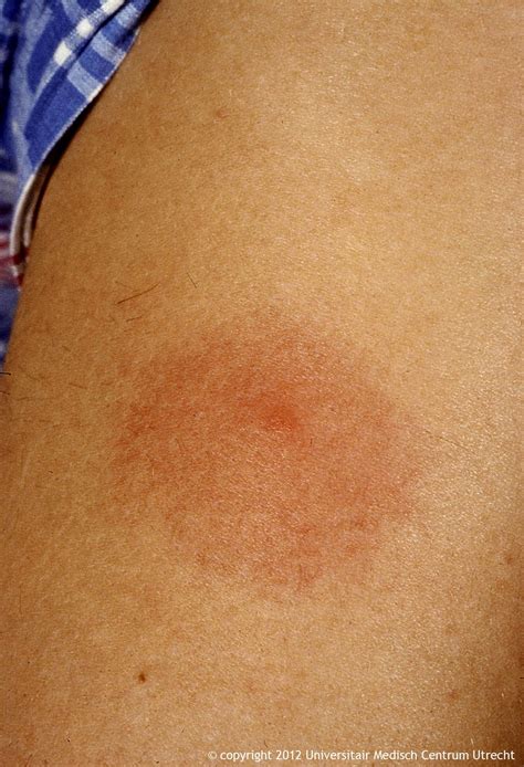 Lyme Rash Erythema Migrans