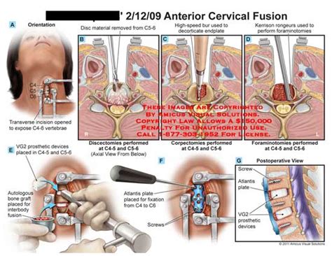 AMICUS Illustration of amicus,surgery,cervical,spine,vertebrae ...