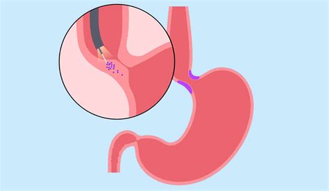 Achalasia: What Is, Causes, Complications, and Symptoms