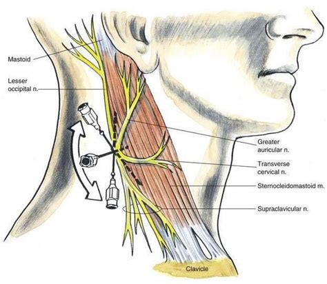 Cervical Plexus Block | Anesthesia Key