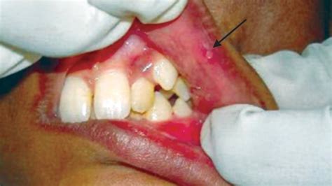 What Causes Lupus Mouth Sores or Ulcers?