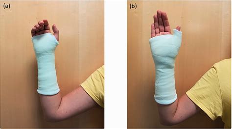 Colles Fracture Splint