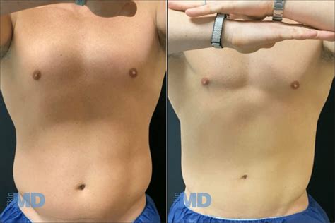 CoolSculpting® Fat Reduction | Boston - Skin MD Laser & Cosmetic Group