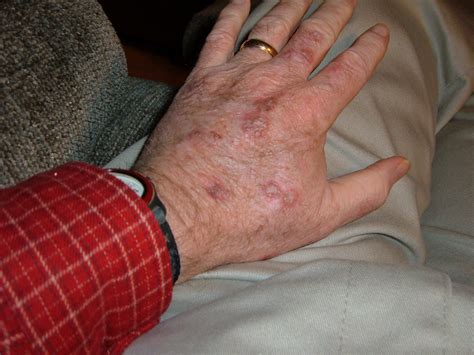 Cancer Lesions On Skin