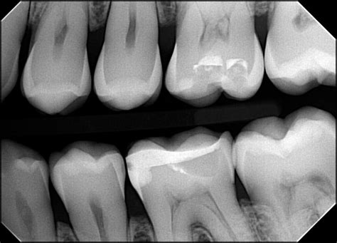 Handheld Intraoral X-Rays