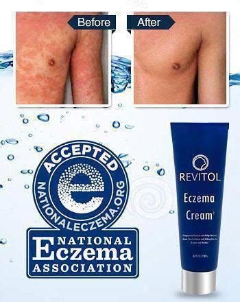 best eczema cream #besteczematreatmentforadults #besteczemacreams ...