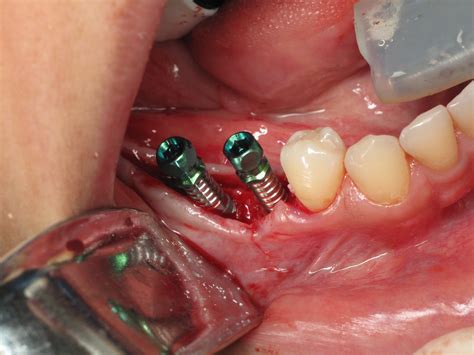 Dental Implant Surgery Infographic Dental Implant Sur - vrogue.co