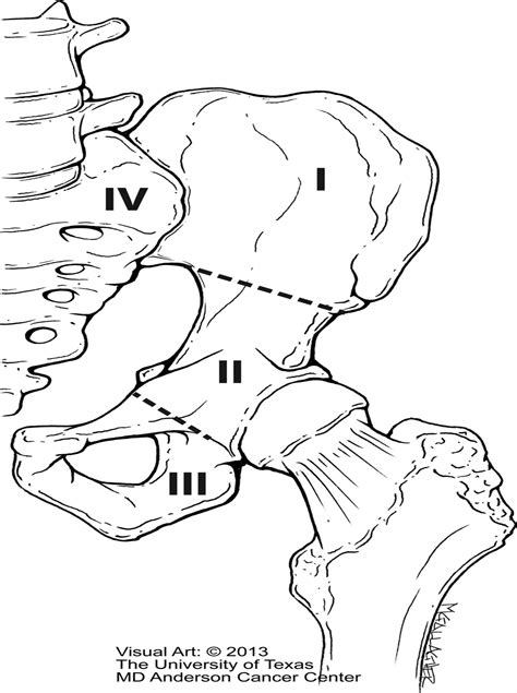 Reconstruction After Internal Hemipelvectomy: Outcomes and R ...