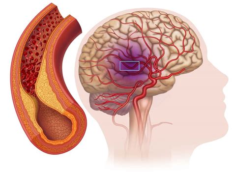 Carotid Stenting vs. Carotid Endarterectomy