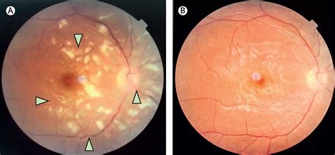 Juvenile systemic lupus erythematosus presenting as retinal vasculitis ...