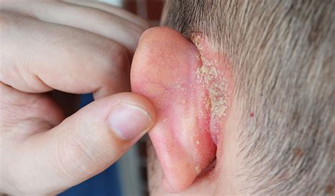 What You Need To Know About That Lump Behind Your Ear