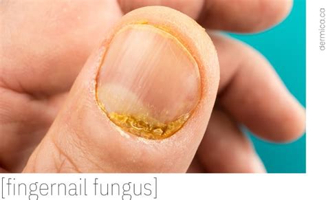 Fingernail Fungus | HAND & NAIL CARE