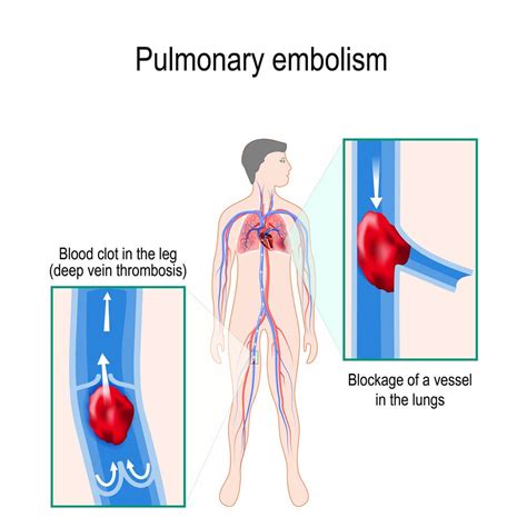 What is A Pulmonary Embolism? | Health Beat