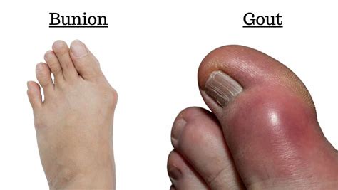 Big Toe Pain: All causes of Big Toe Pain Explained by a Specialist