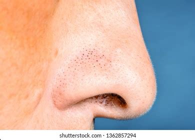 Black Dots On Nose Alae Stock Photo 1108913288 | Shutterstock