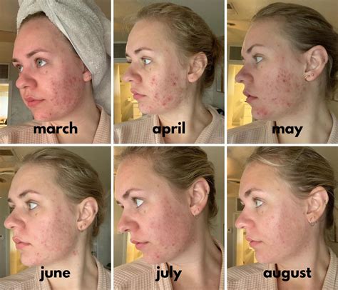 [B&A] Hormonal Acne 6 Month Progress - Spironolactone / Aczone / Retin-A (routine in comments ...