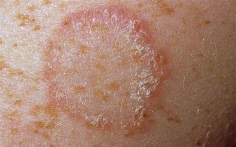 Fungal Rash On Skin