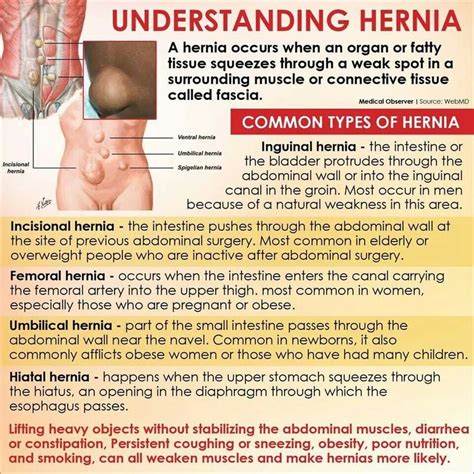 Understanding Hernia | Hernia inguinal, Bladder, Abdominal