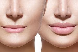 Best Lip Lift Surgeons in Turkey - Find Cost Estimate, Reviews, Before and After Photos and Book ...